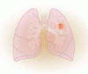 非小細胞肺癌患者の生存転帰の改善