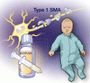 I 型脊髄性筋萎縮症を治療する