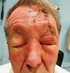 頭皮と顔面に皮疹を呈する男性