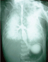 気管支食道瘻を伴った気管無形成