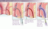 炎症性腸疾患に対する最新の生物学的製剤治療と低分子治療