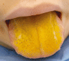 黄疸が現れた舌