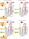 AKI に対する体外循環による腎代替療法