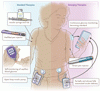 1 型糖尿病小児の血糖を管理する