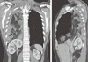 成人における先天性横隔膜ヘルニア