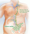 乳び腹水を認めた男性