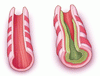 気管支拡張症 ― 臨床レビュー