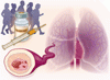 肺動脈性肺高血圧症に対するソタテルセプト