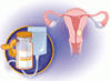 子宮体癌に対するドスタルリマブ