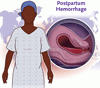 分娩後出血の早期発見と治療
