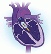 低リスク患者に対する TAVR と外科的弁置換術の 5 年後の転帰の比較