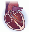 STEMI と心原性ショックに対する小型軸流ポンプ