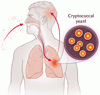 多様な宿主におけるクリプトコッカス症