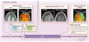 血液脳関門とアルツハイマー病