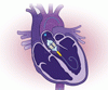 心不全に対する心臓再同期・除細動治療